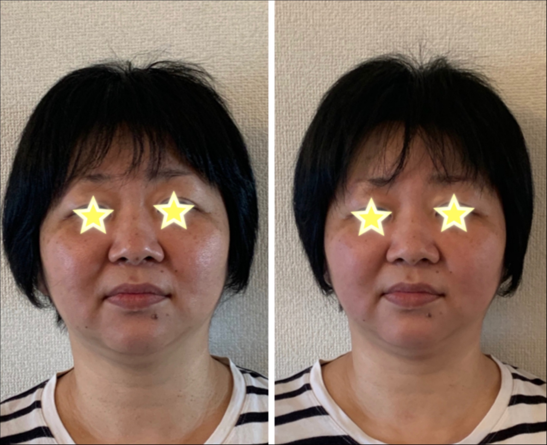 1ヶ月間
マッサージを行った方のビフォー(左)
アフター(右)写真です。